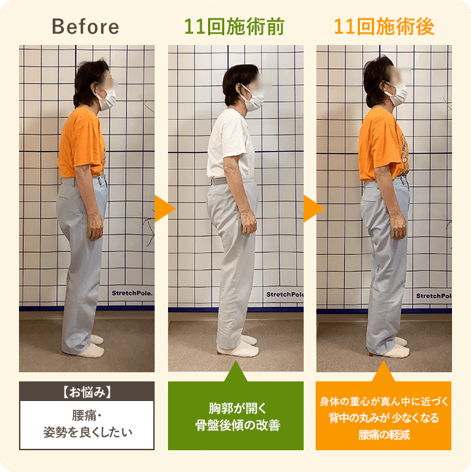 70代女性姿勢改善ビフォーアフター